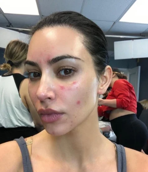 kim kardashian psoriasis